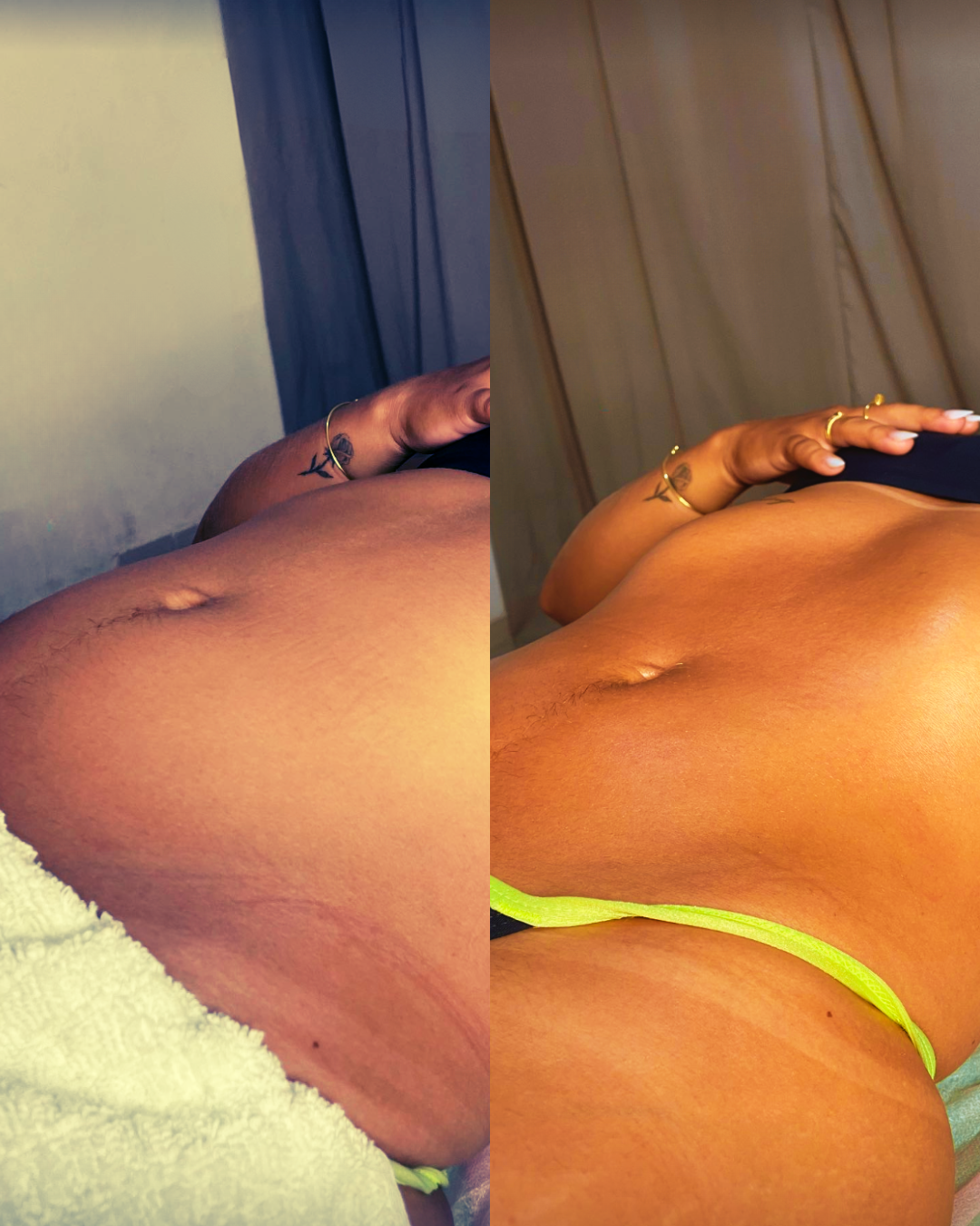 Antes e depois de um tratamento Corporal